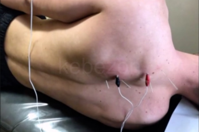 Assessment-Electro-Acupuncture-treatment-of-Intrascapular-Pain-by-Anthony-Lombardi-free-download