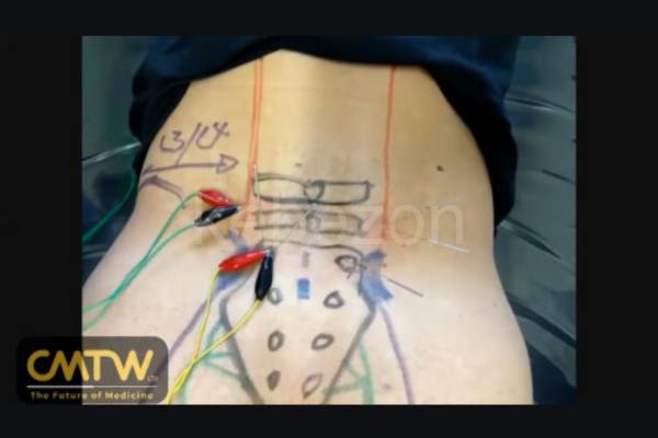 Assessment-Treatment-of-Lumbar-Spinal-Stenosis-Using-Electro-Acupuncture-by-Anthony-Lombardi-free-download